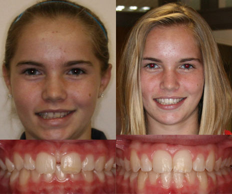 before and after