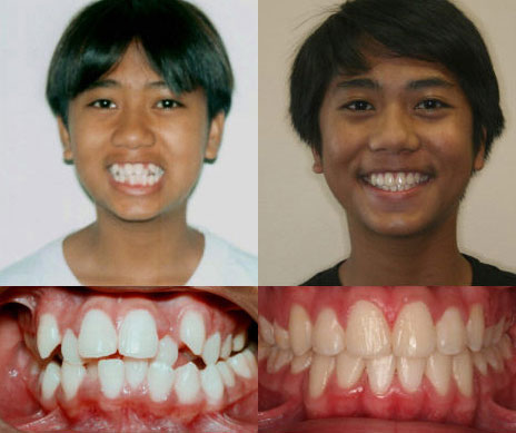 before and after