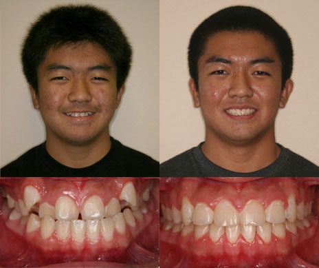 before and after