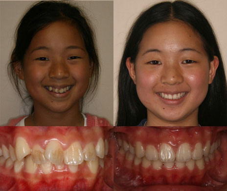 before and after