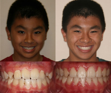 before and after