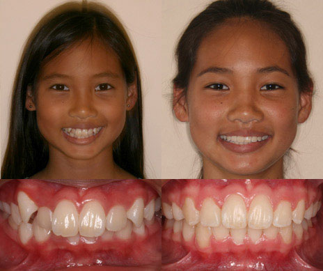 before and after