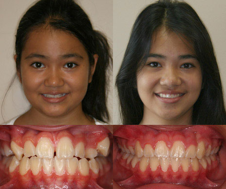 before and after