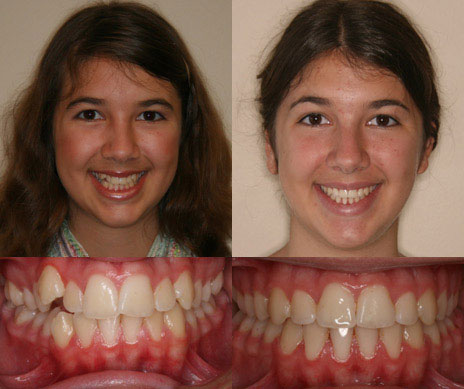 before and after
