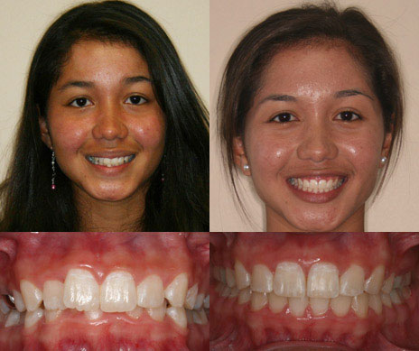 before and after