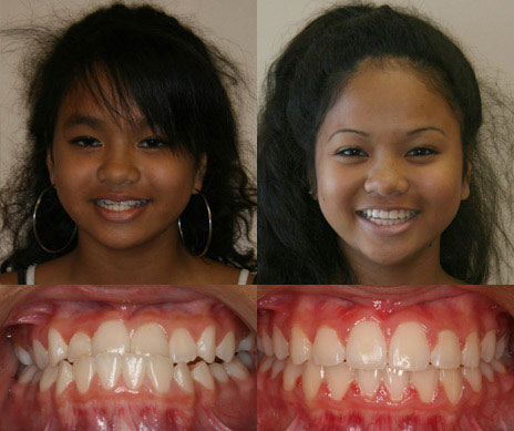 before and after